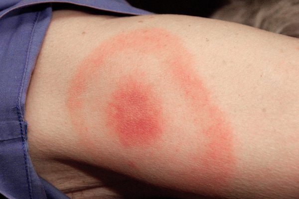 S_0817_lyme-disease_C0031417.max-600x600.jpg