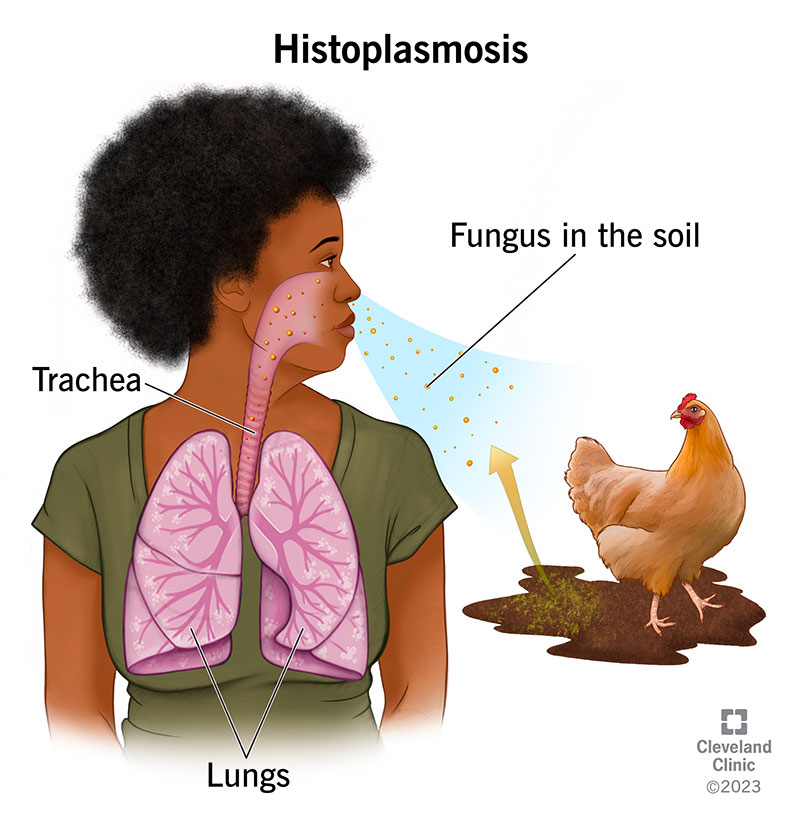 24811-histoplasmosis.jpg